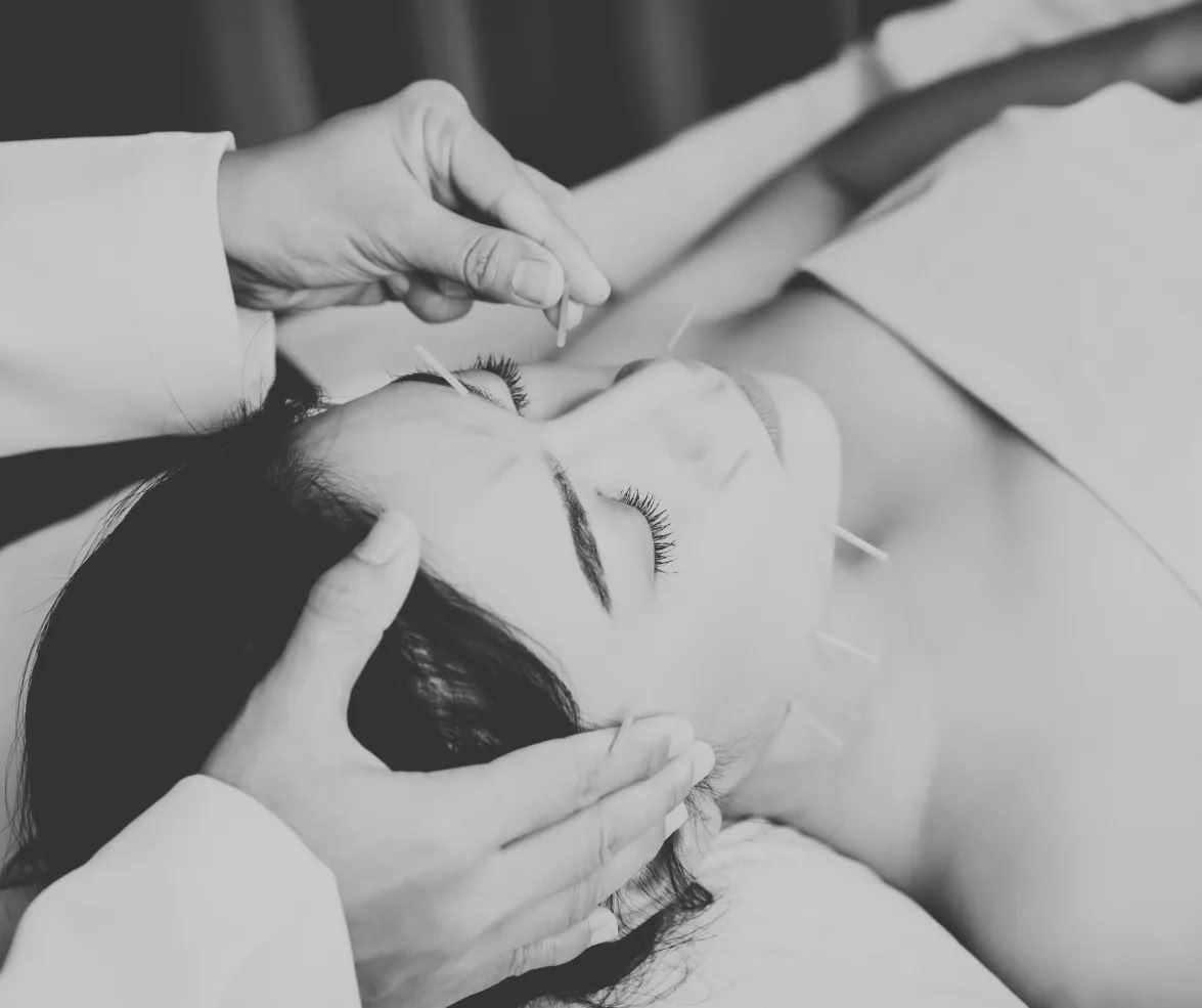 Facial Acupuncture
