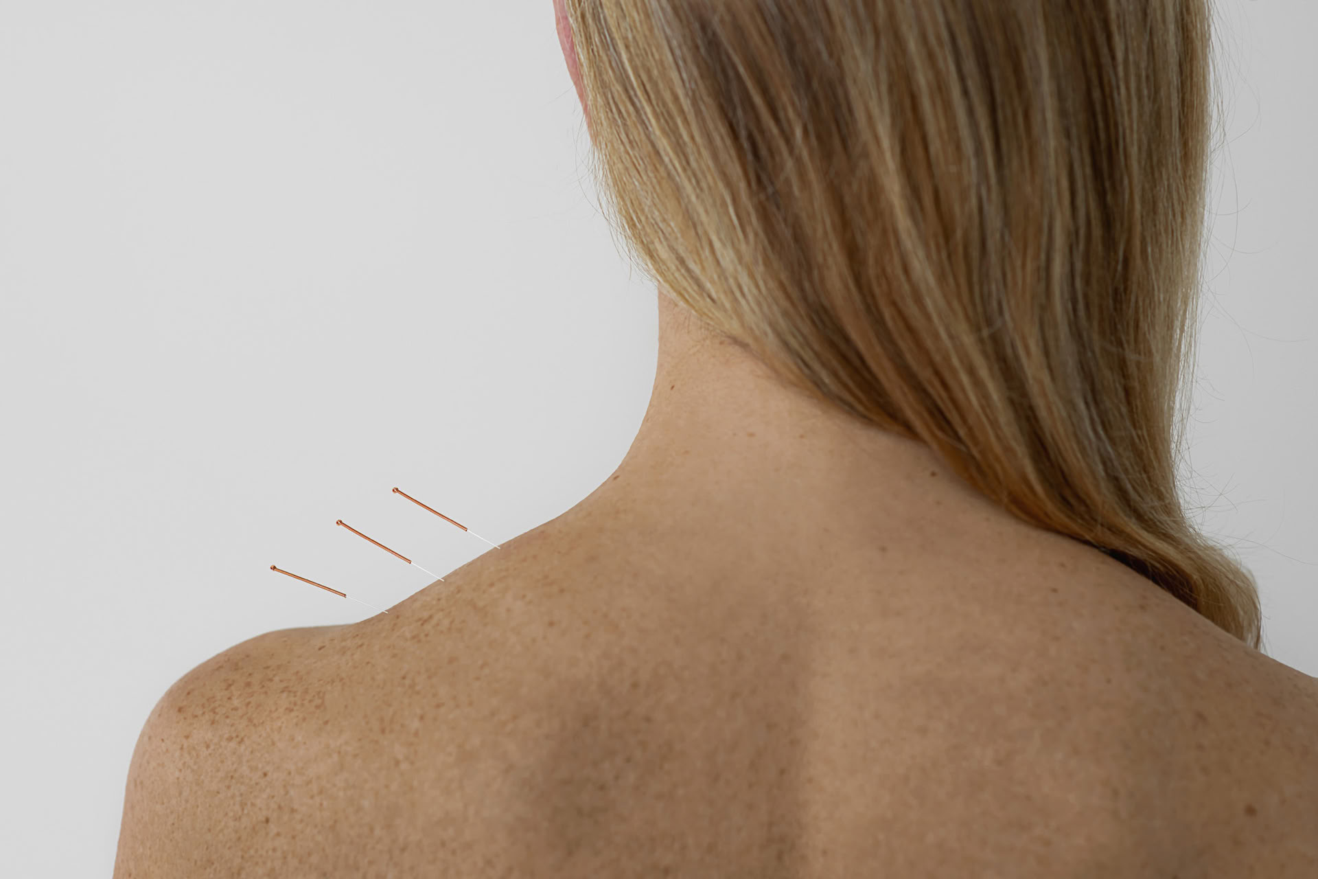 Acupuncture