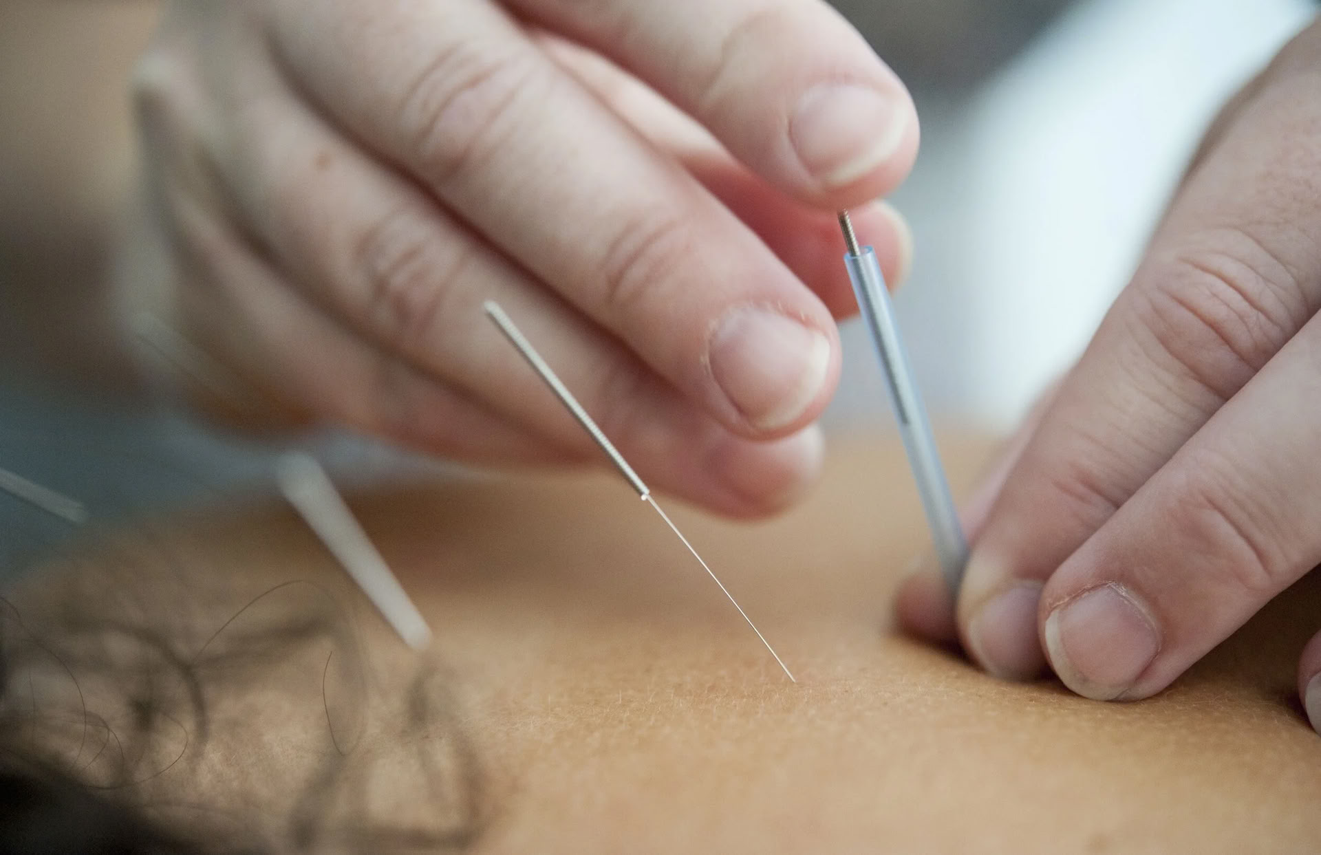 $95 First Visit - Acupuncture Session