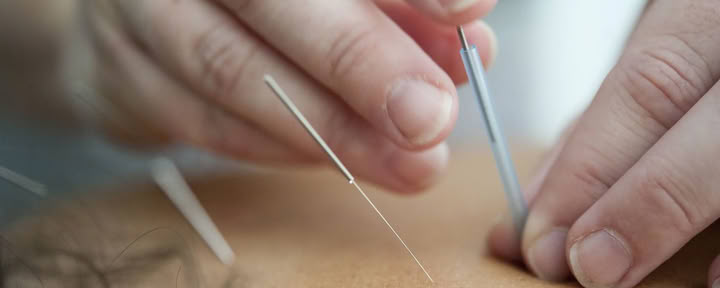 $95 First Visit - Acupuncture Session