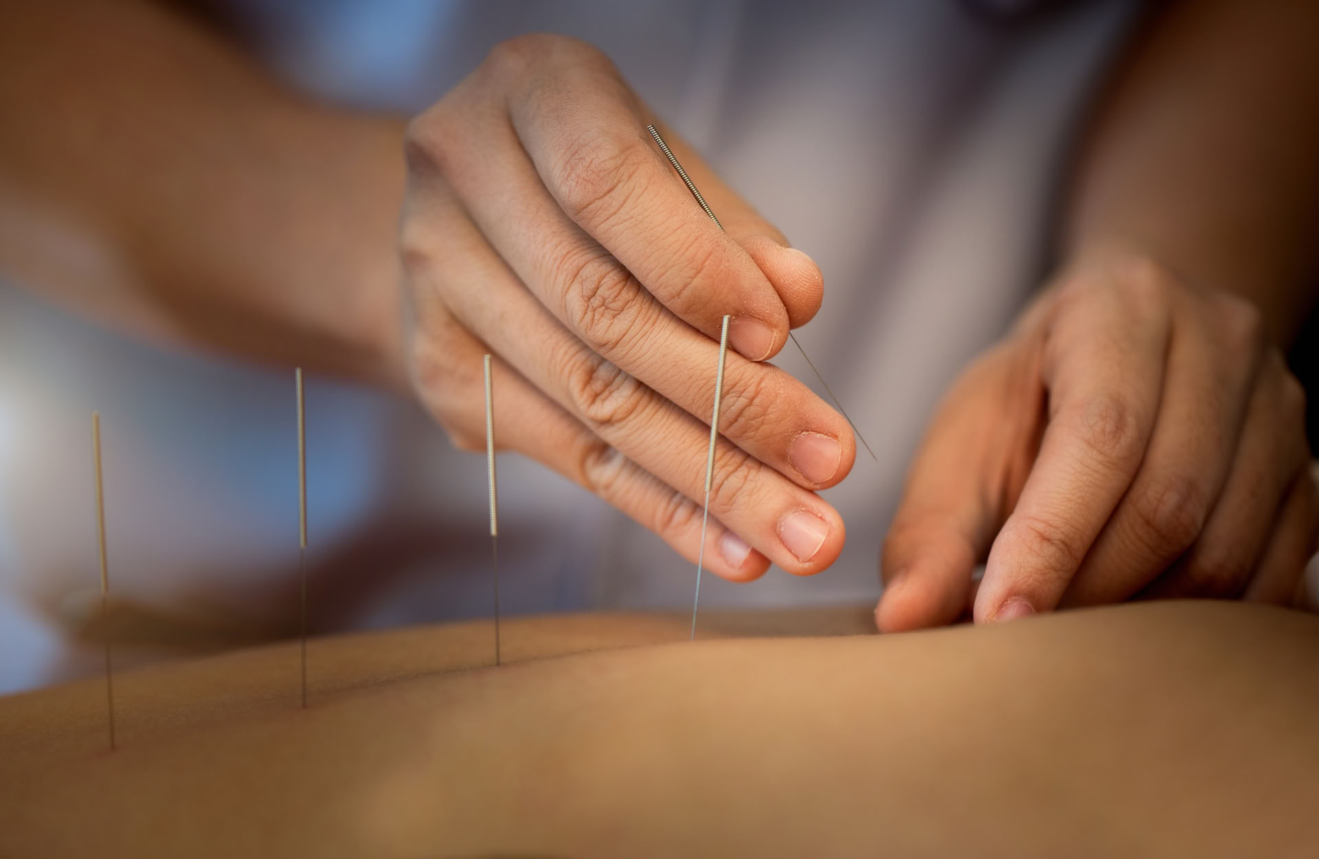 Acupuncture 1:1 Therapy Session in Ubud