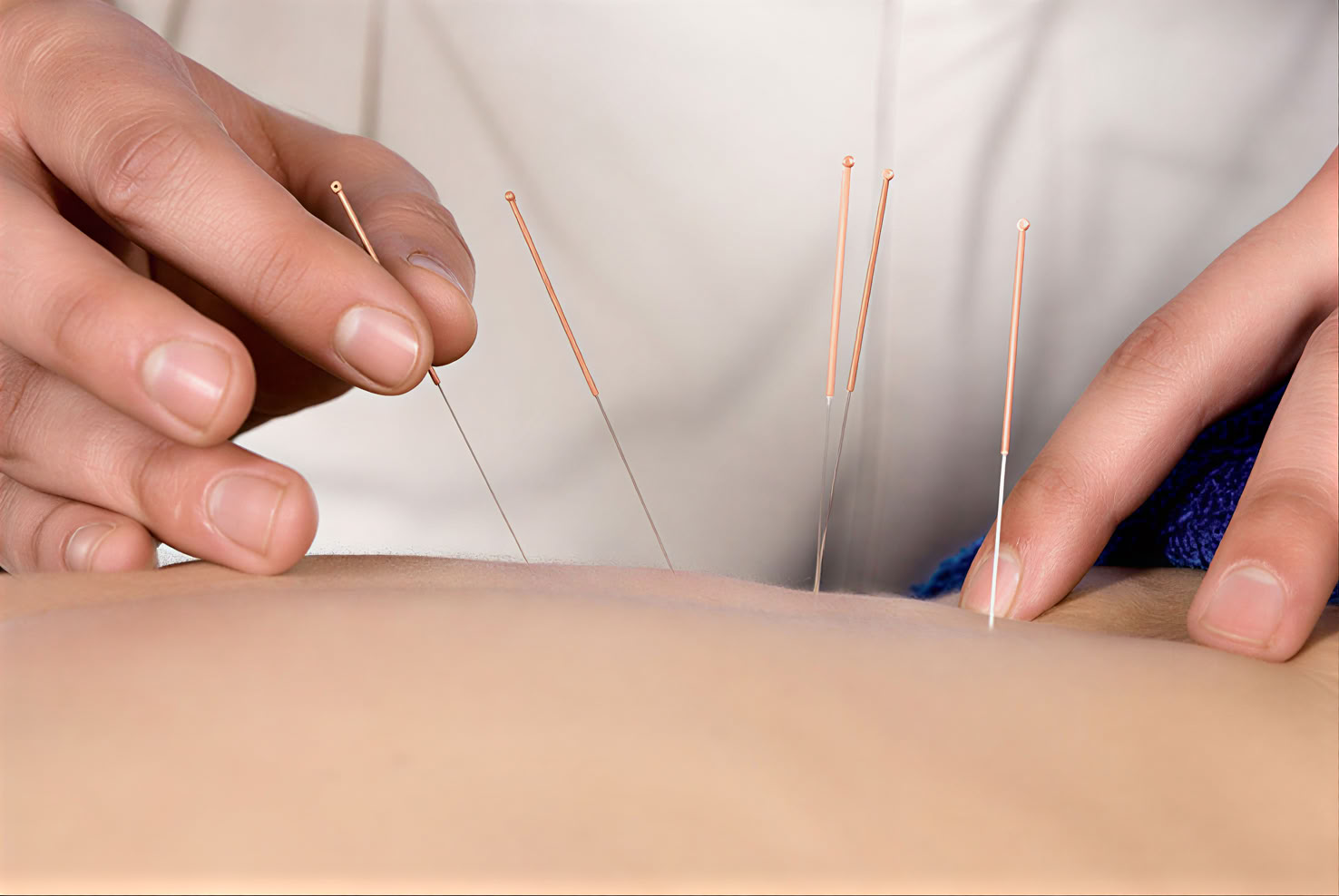 Acupuncture 1:1 Therapy Session in Ubud